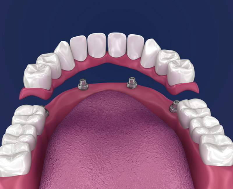 all on 4 dental implant near you in sw calgary