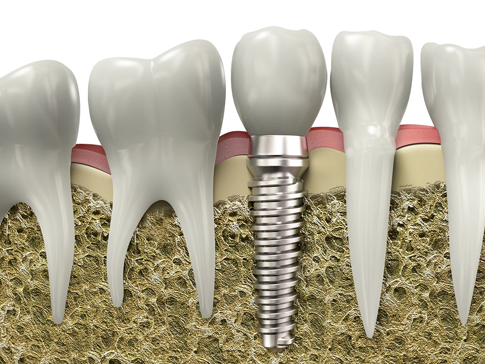 dental implants near you in sw calgary