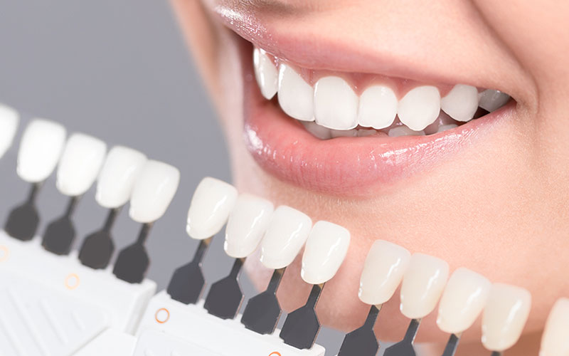 porcelain veneers near you in sw calgary