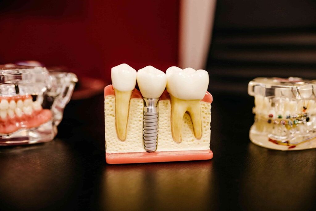 why more people are opting for dental implants
