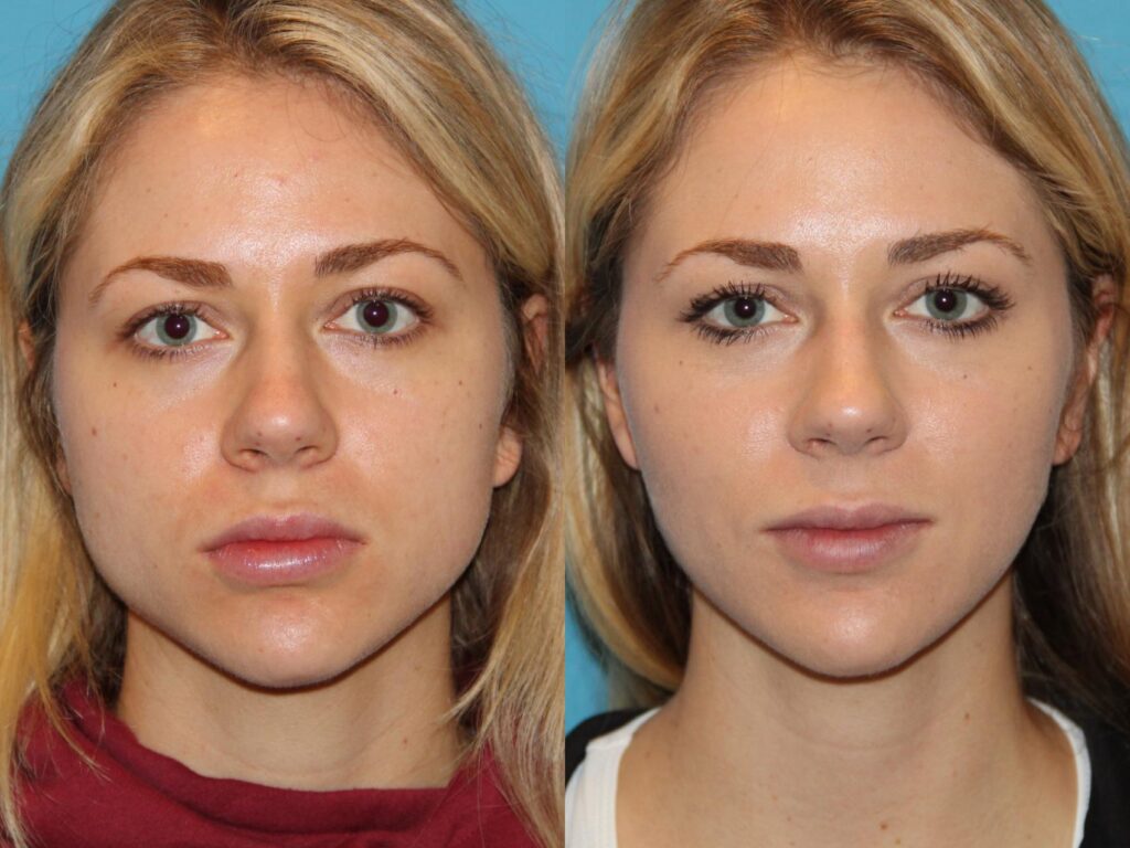 A woman receiving Botox injections along her jawline for a more contoured and defined facial appearance.