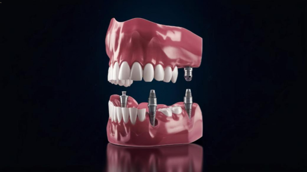 all-on-4 dental implants near you